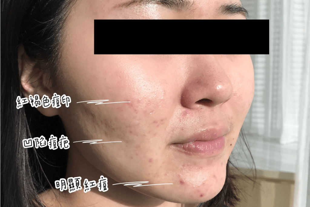 肌膚的痘痘問題