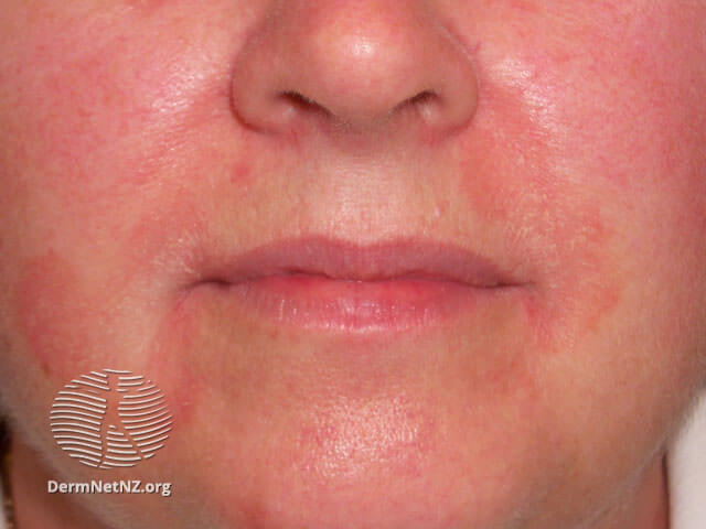 臉部脂漏性皮膚炎