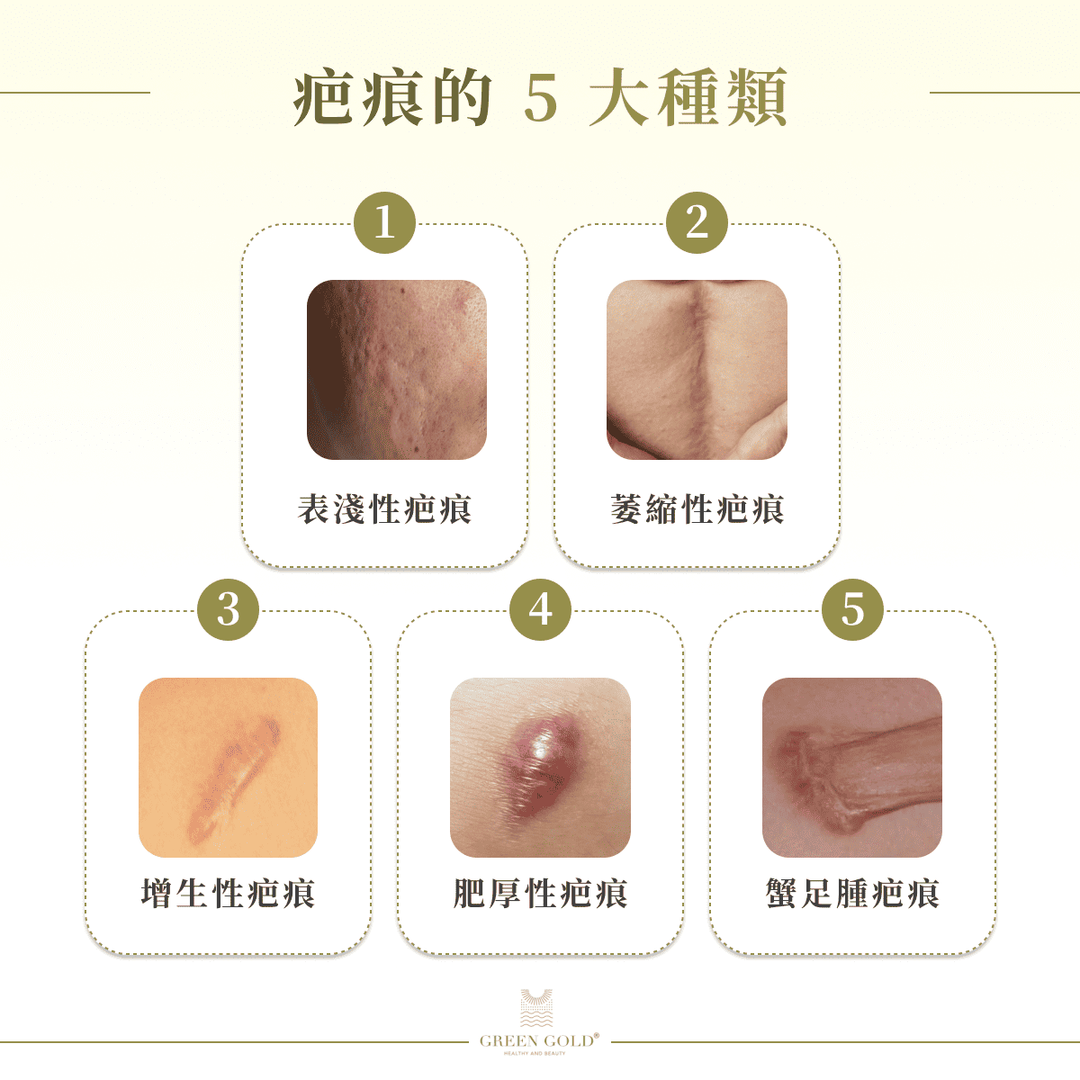 疤痕的 5 大種類