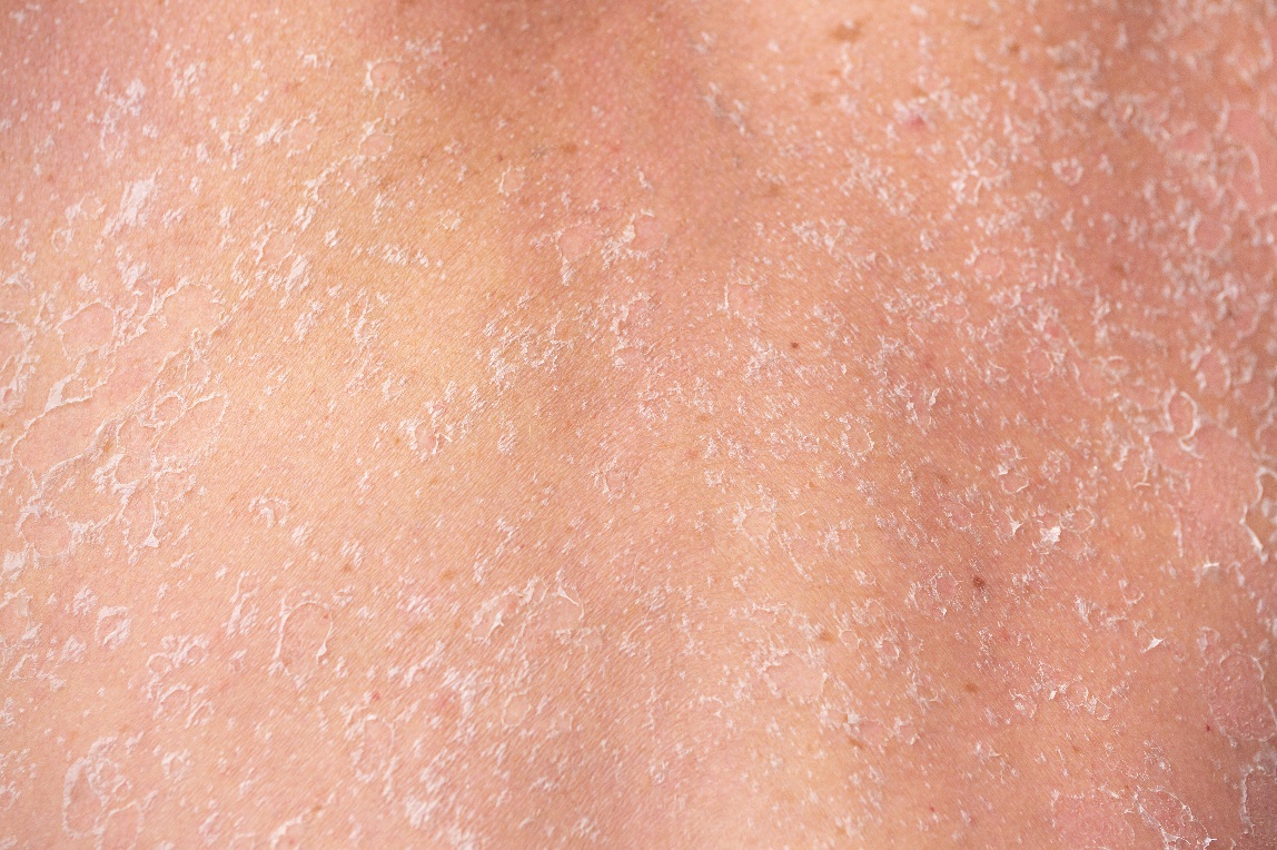 引發皮膚乾燥脫皮的6大因素