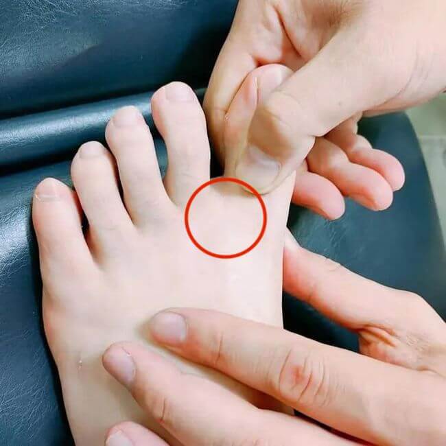 拇指外翻不要穿夾腳拖