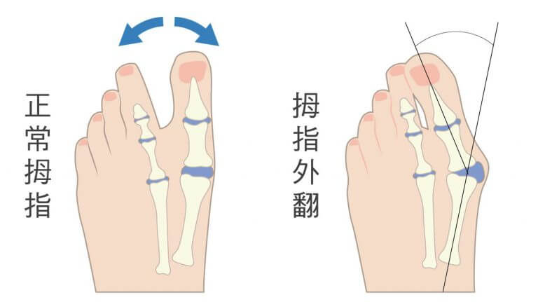 拇指外翻是什麼,如何判斷拇趾外翻