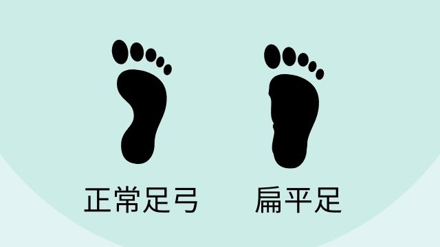 如何判斷自己是否有扁平足