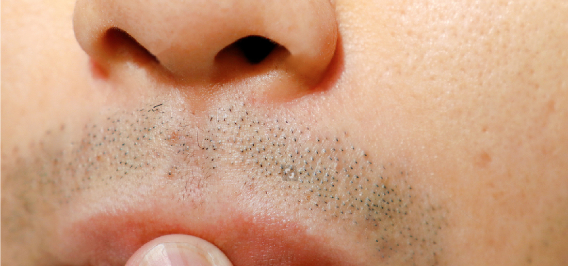 熱蠟除毛–解決23%男性鬍渣的困擾