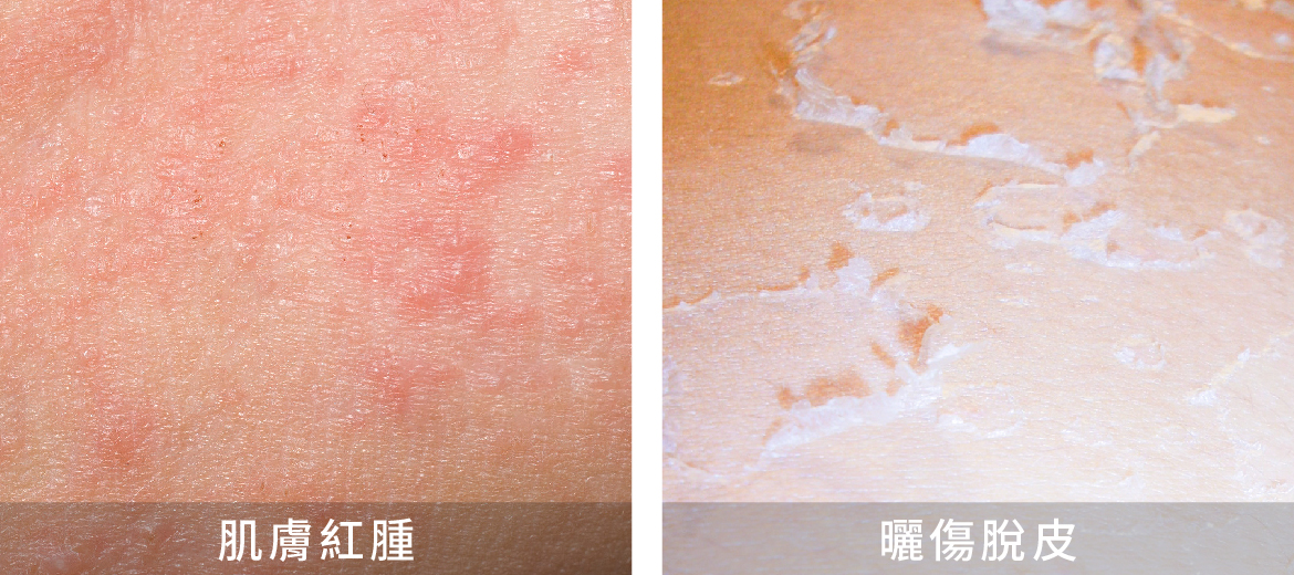 熱蠟除毛要注意:避免皮膚有傷口