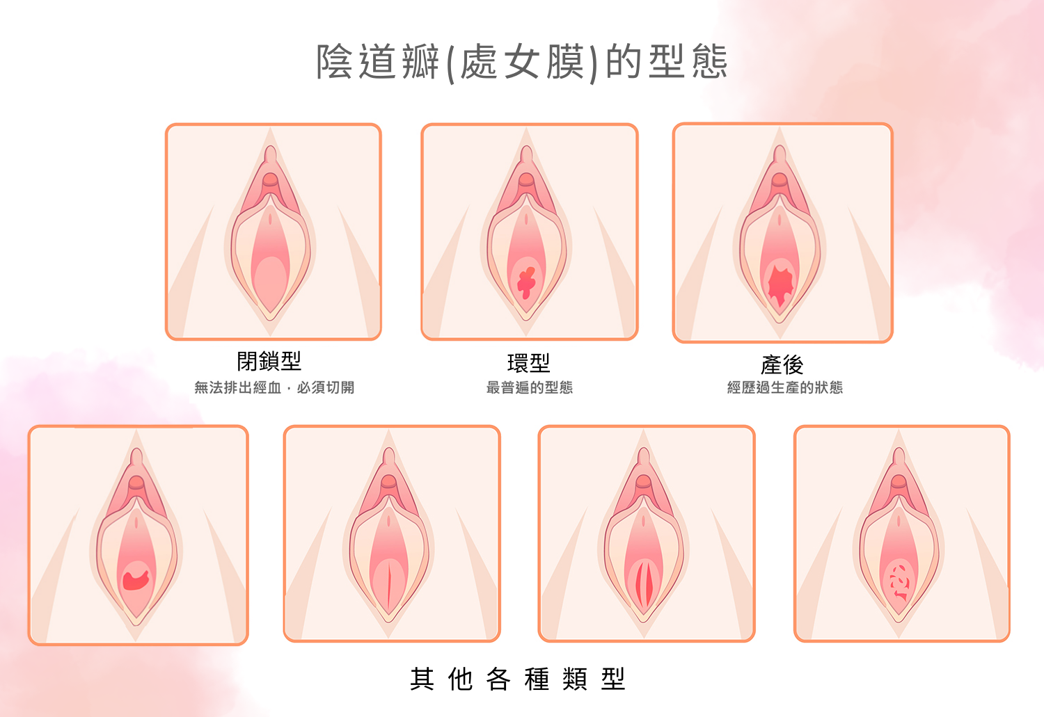 有些女孩在發生第一次性行為時會有疼痛感或異物感,主要是因為陰道瓣(俗稱處女膜)這塊環形組織受到拉扯