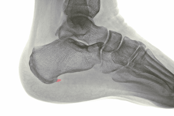 骨刺形成示意圖