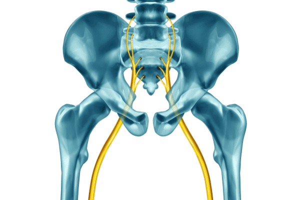 坐骨神經痛示意圖