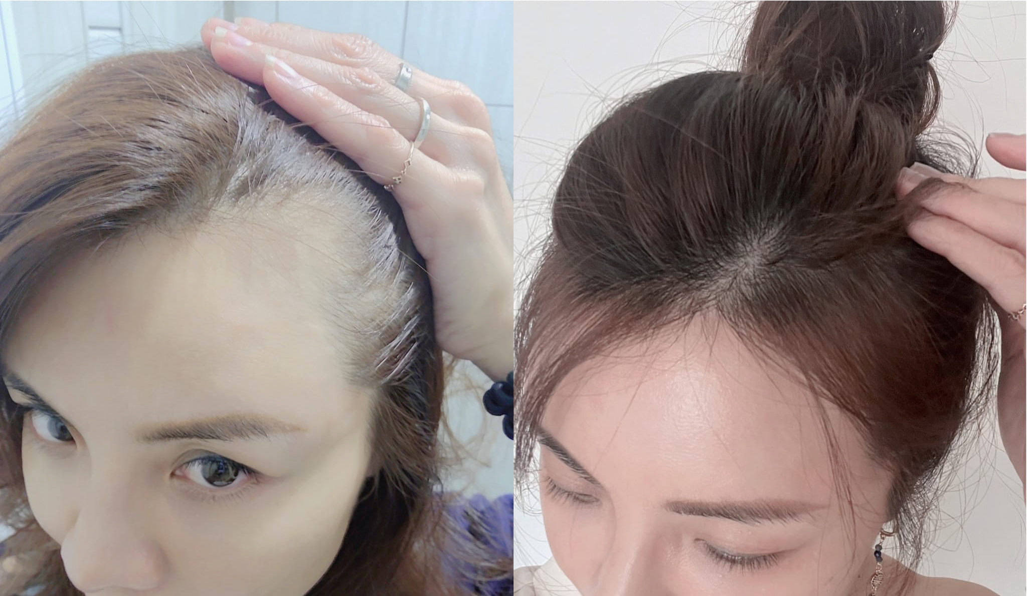 Dcard的預防掉髮產品推薦,不用擔心掉髮嚴重怎麼辦,掉髮要看哪科了