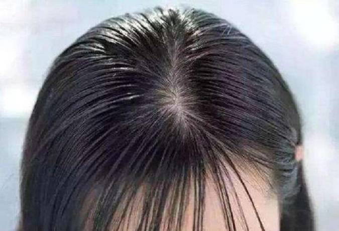 以前頭皮出油特別厲害