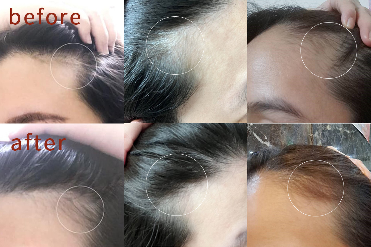 Ovie植萃養髮液生髮實測