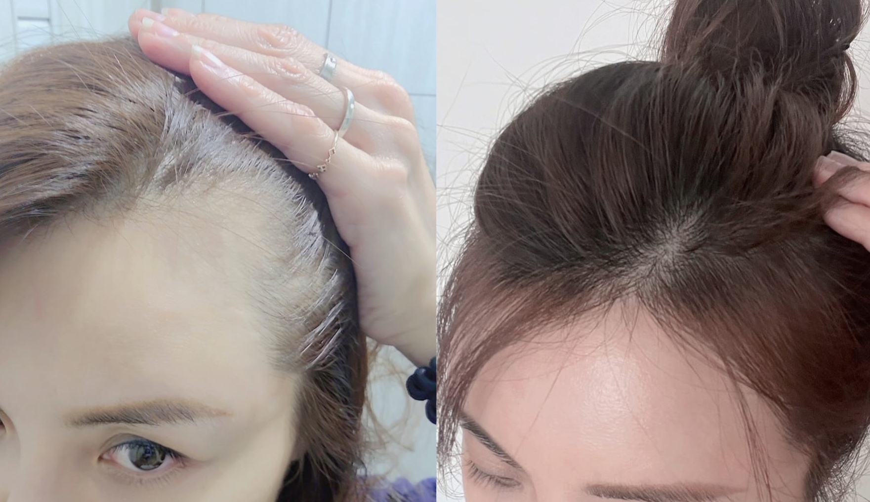 Dcard的預防掉髮產品推薦,不用擔心掉髮嚴重怎麼辦,掉髮要看哪科了