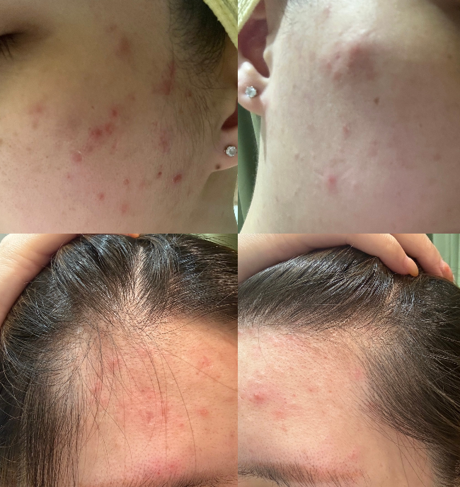 季節轉換、生理期來、壓力大、免疫力下降就會引發一系列爆!痘!肌膚脫皮、泛紅、刺癢、紅腫的敏感肌!也是容易出油,容易毛孔堵塞造成黑頭粉刺、毛孔粗大的油痘族...