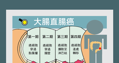 【A4海報】大腸直腸癌