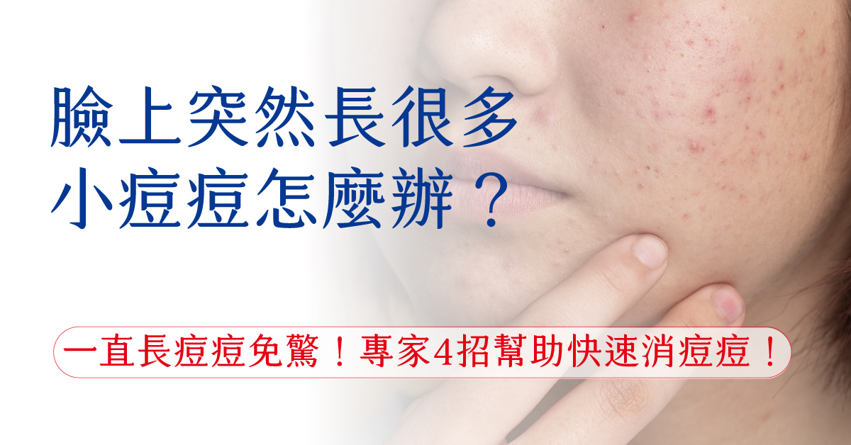 臉上突然長很多小痘痘怎麼辦?一直長痘痘免驚!專家4招幫助快速消痘痘!