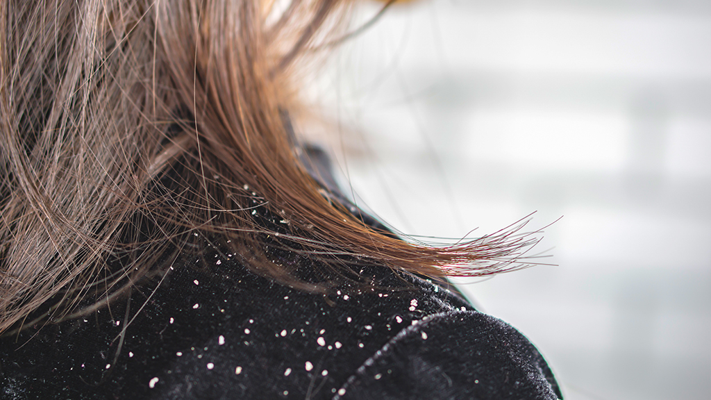 皮脂分泌過剩容易產生頭皮屑