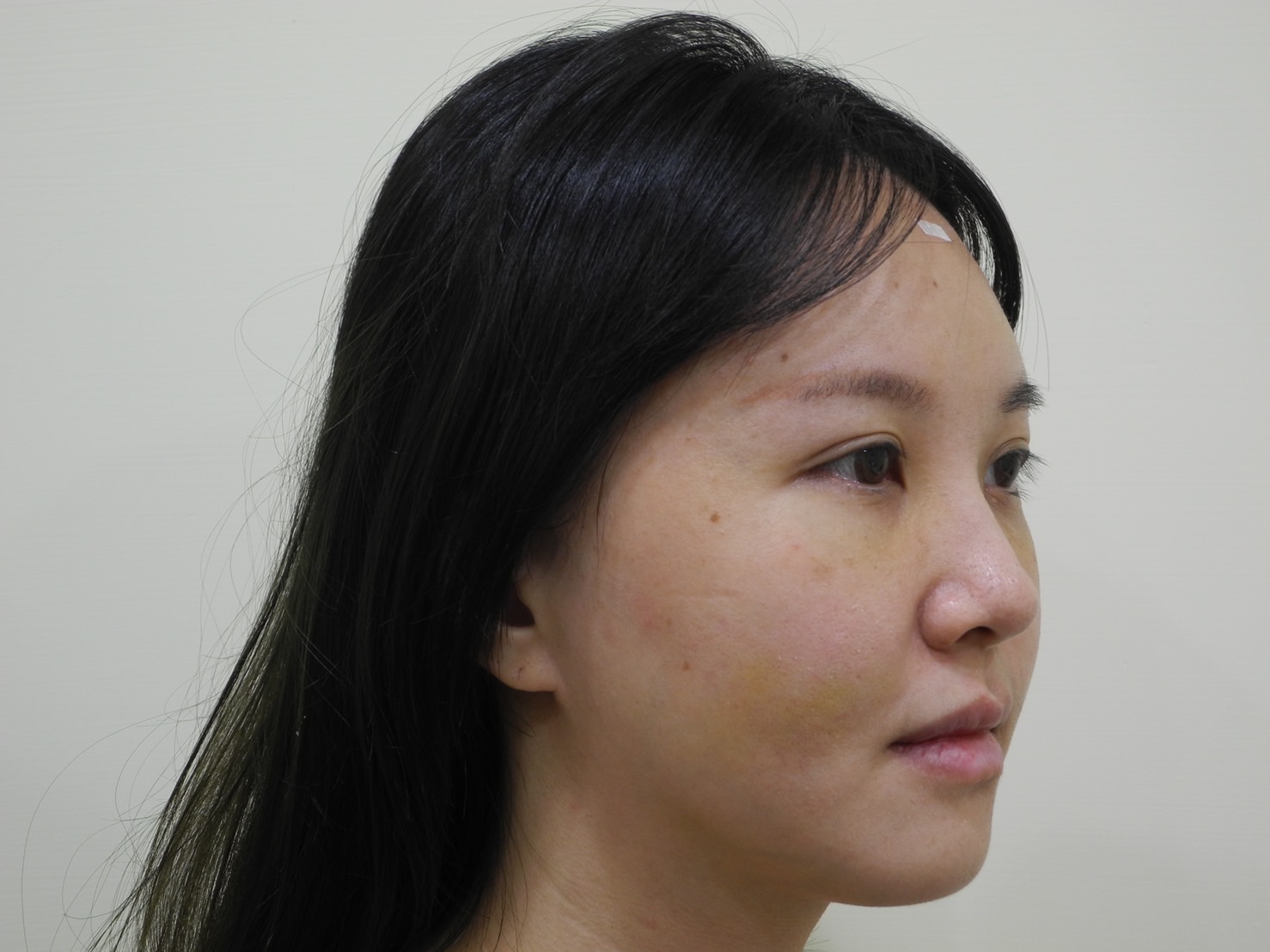 自體脂肪補臉手術後兩週