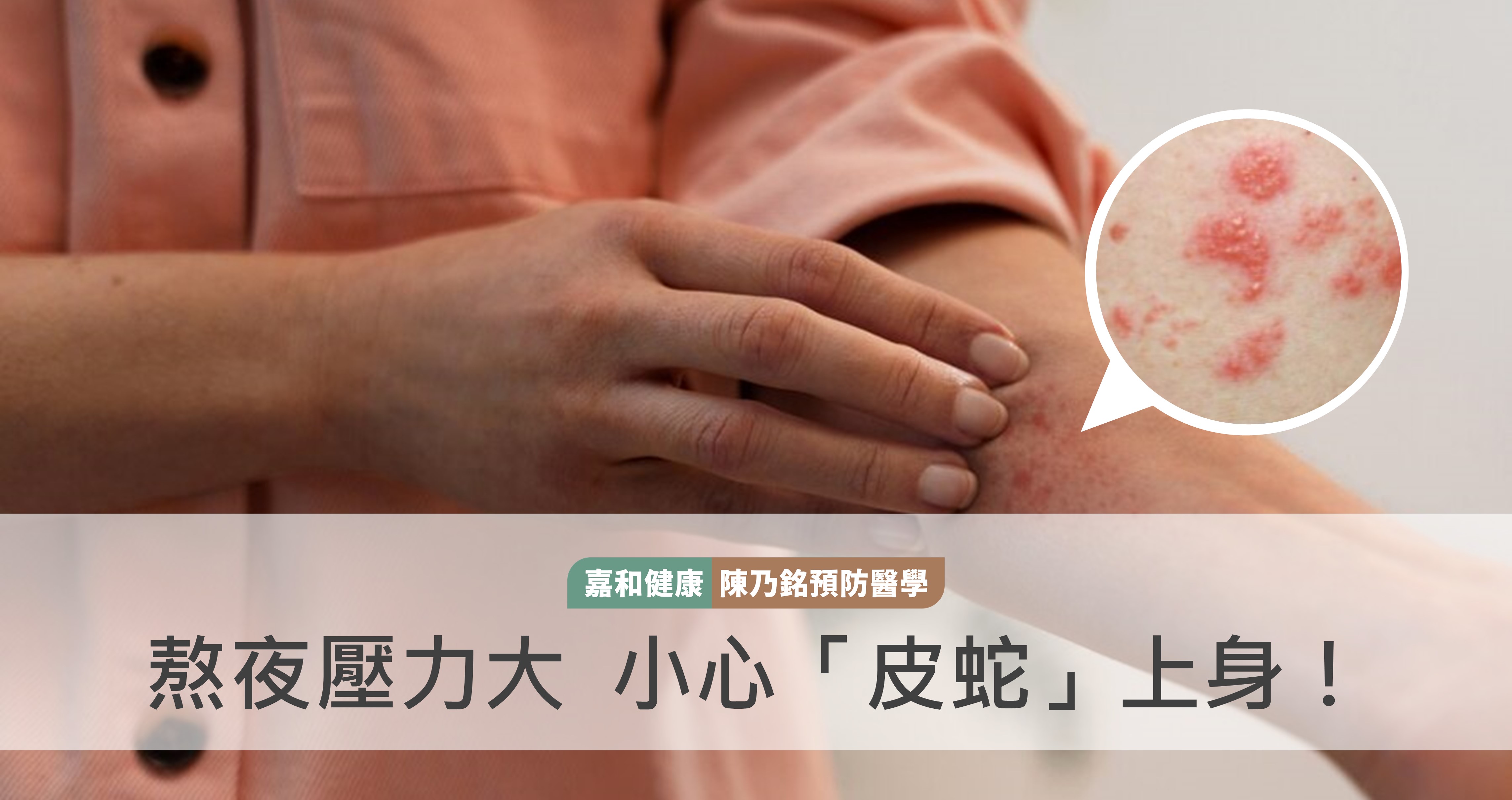 熬夜壓力大  小心「皮蛇」上身！