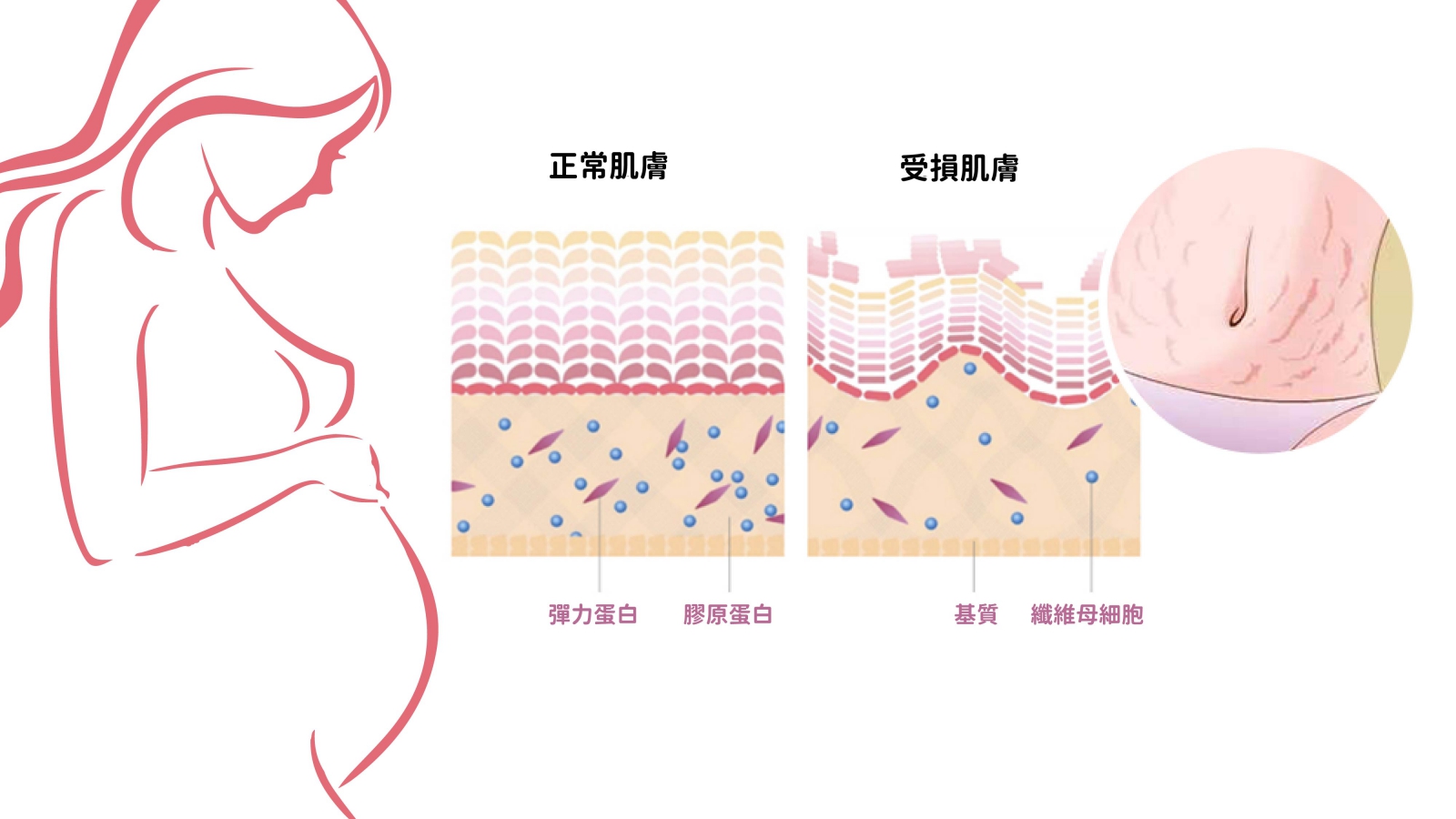 【無痕模式ING】搶救妊娠紋大作戰