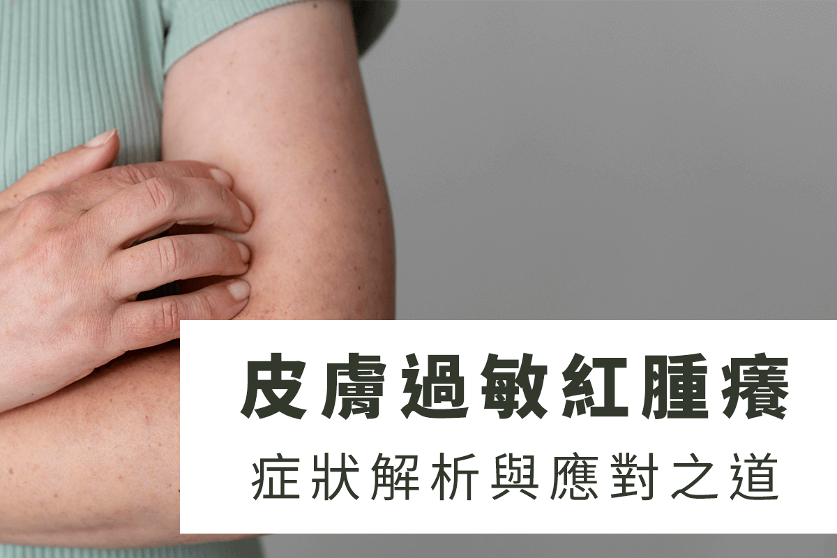 皮膚過敏紅腫癢！症狀解析與應對之道