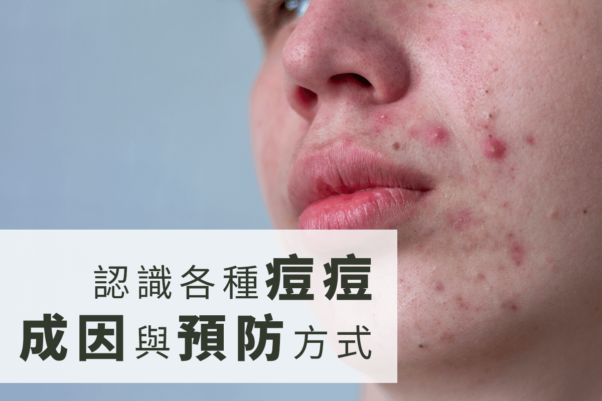 認識各種痘痘成因與預防方式