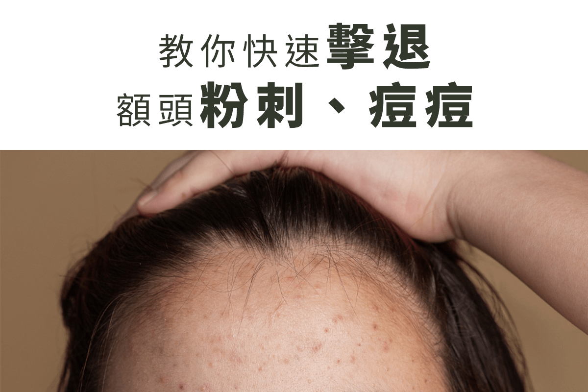 額頭長粉刺、痘痘，一直消不了，教你快速擊退額頭粉刺、痘痘