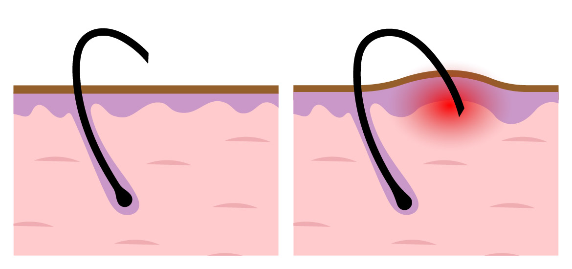 皮層外毛髮的穿透