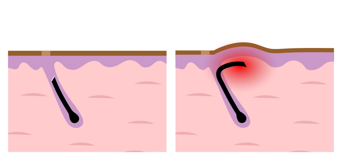 斷毛的皮層穿透