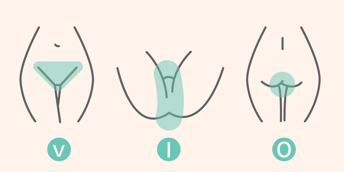 VIO除毛(V:比基尼區、I:陰唇範圍、O:肛門周圍)
