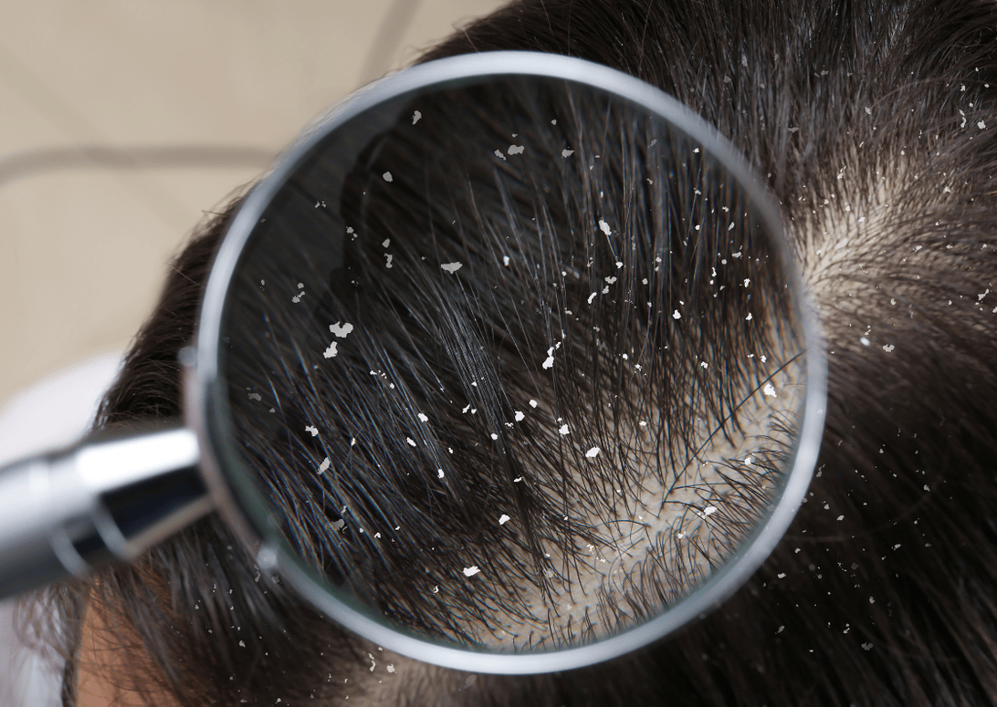 每天洗頭還是有屑？可能不是沒洗乾淨，而是頭皮偏乾