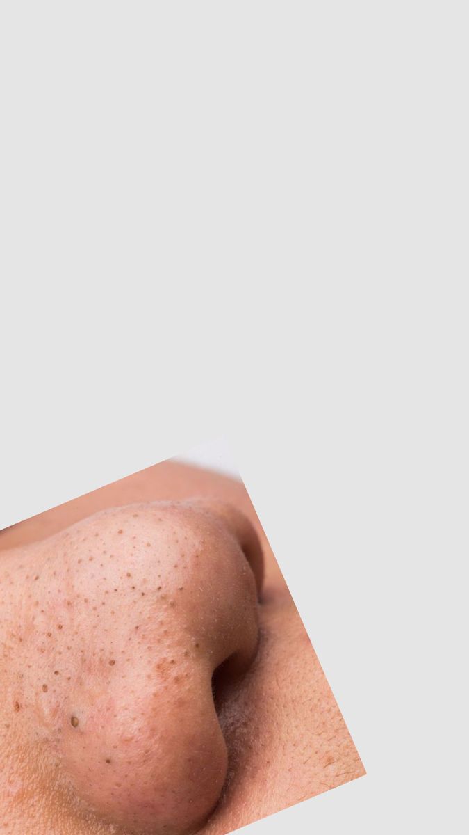 閉鎖粉刺怎麼消？解析內包粉刺成因，敏弱肌不刷酸的「泥膜代謝法」