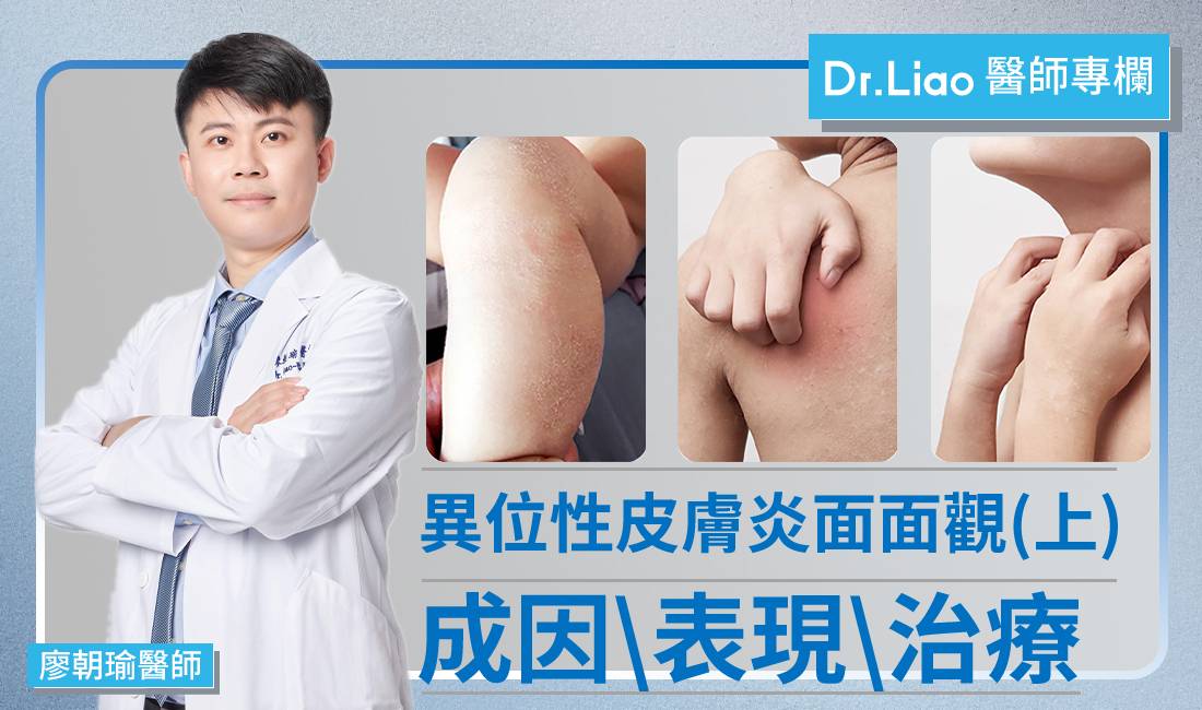 【廖朝瑜醫師專欄】異位性皮膚炎面面觀(上):淺談成因、臨床表現與治療