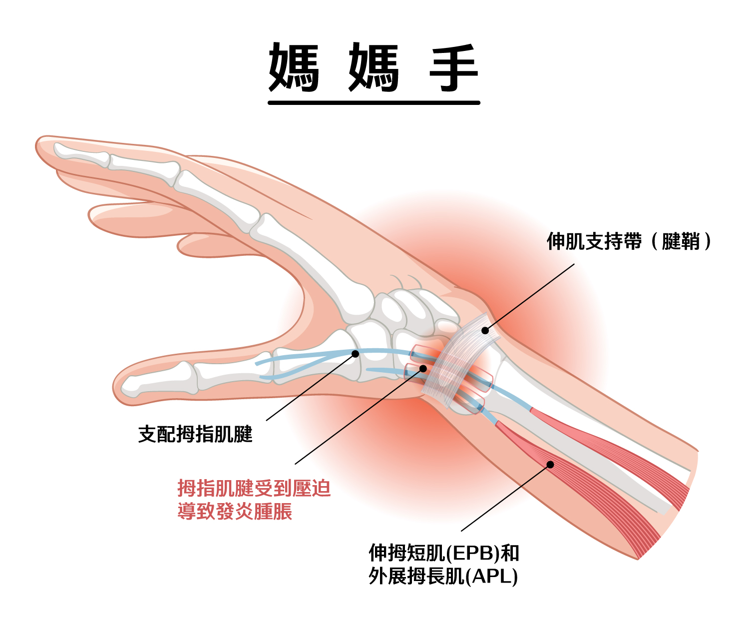 媽媽手結構示意圖-顯示拇指肌腱與腱鞘位置