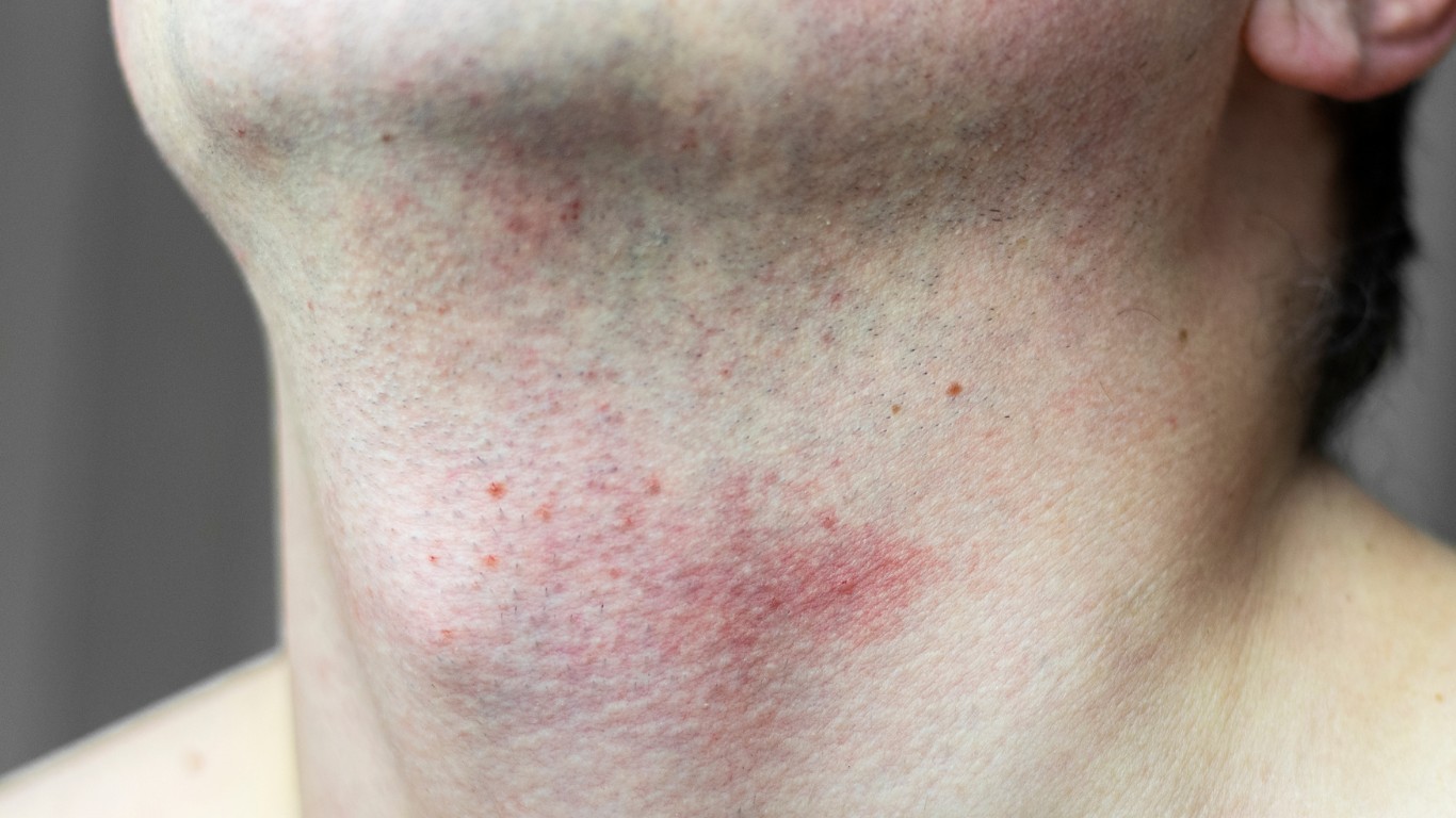 過度去角質會導致皮膚屏障受損，乾燥情況加劇。