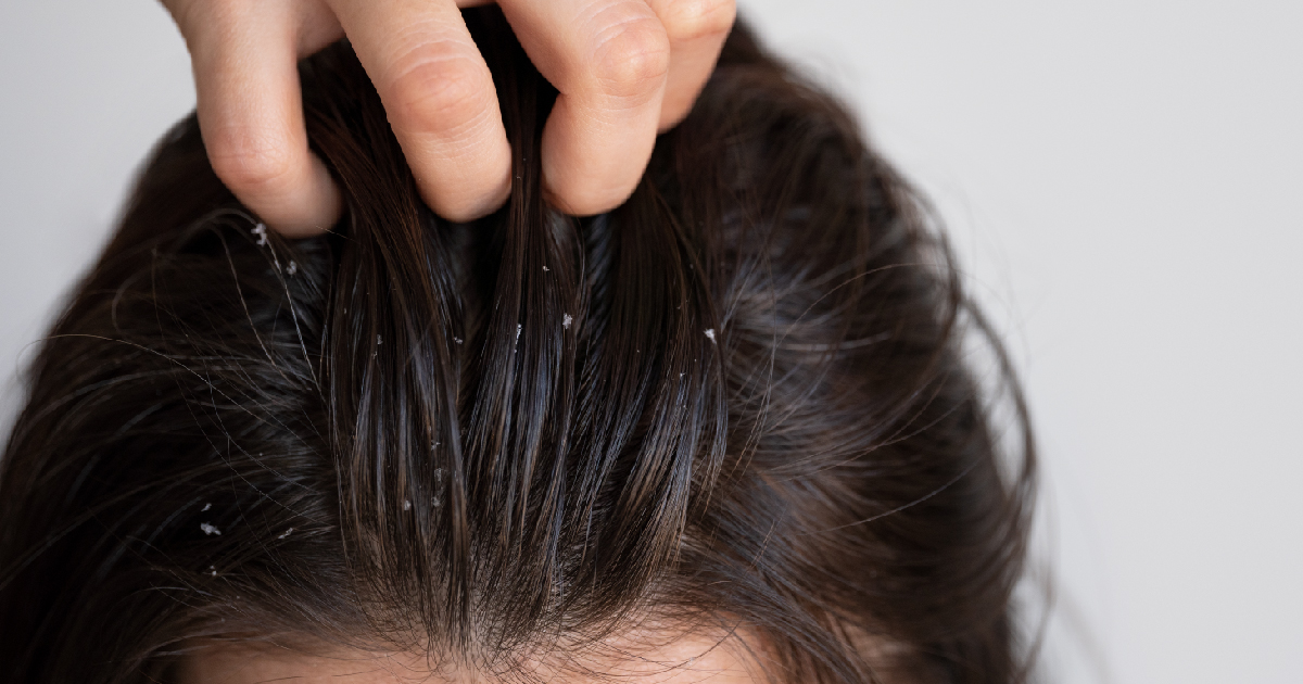 頭皮味原因大解析，帶你了解為什麼頭皮味洗不掉