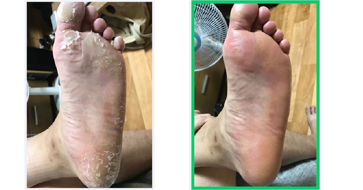會怕真的不要用!! 脫掉一層皮