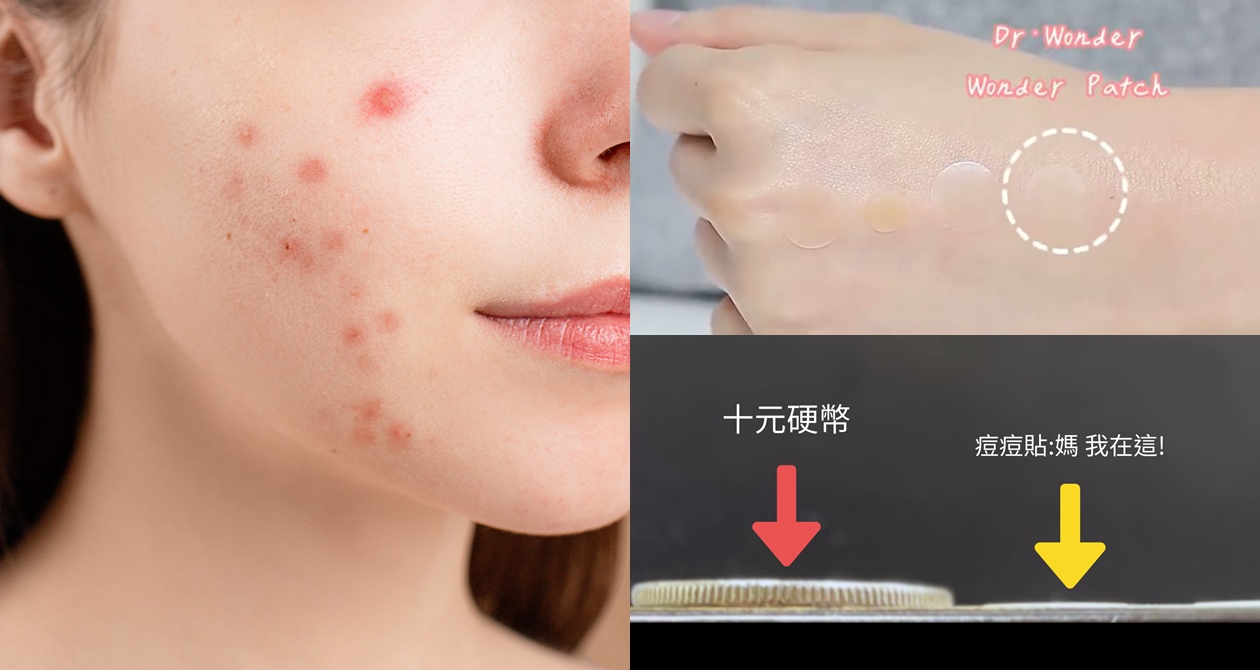 痘痘貼大評比!!! 「這款」痘痘貼真的直接勝出