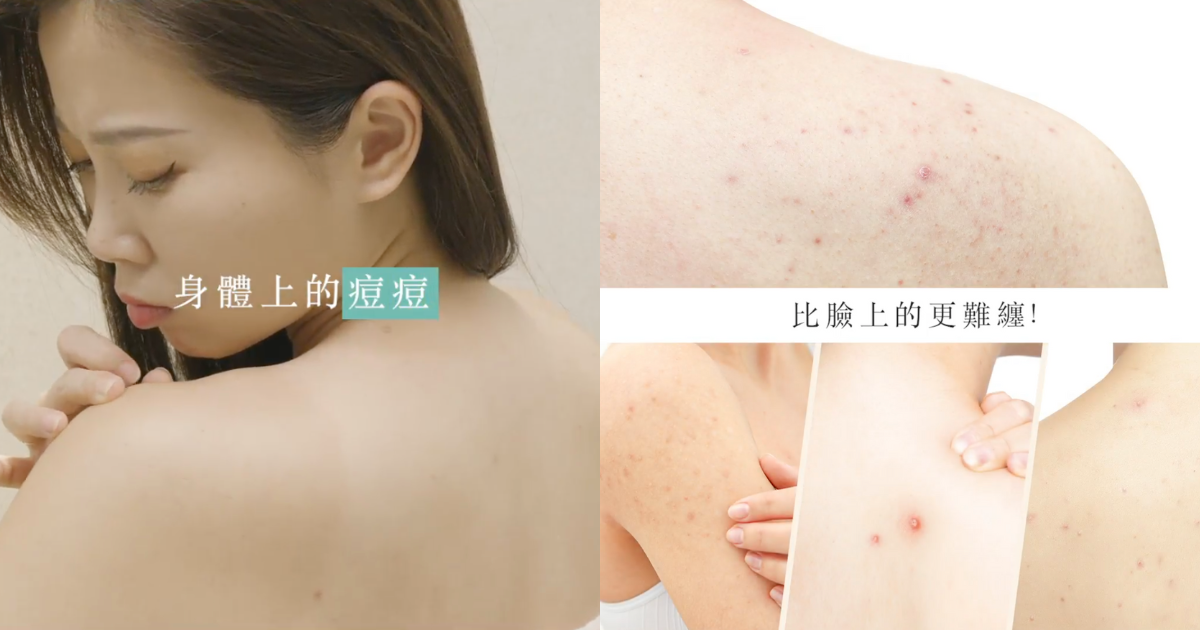 【背痘警報⚠️】夏天一熱背上就冒痘？洗澡這樣做才有效！