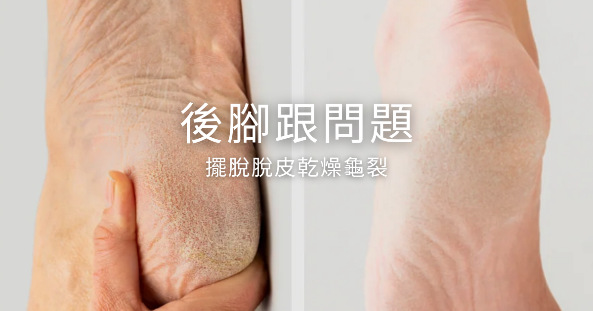 穿涼鞋也不怕！拯救粗糙後腳跟，只要這一招